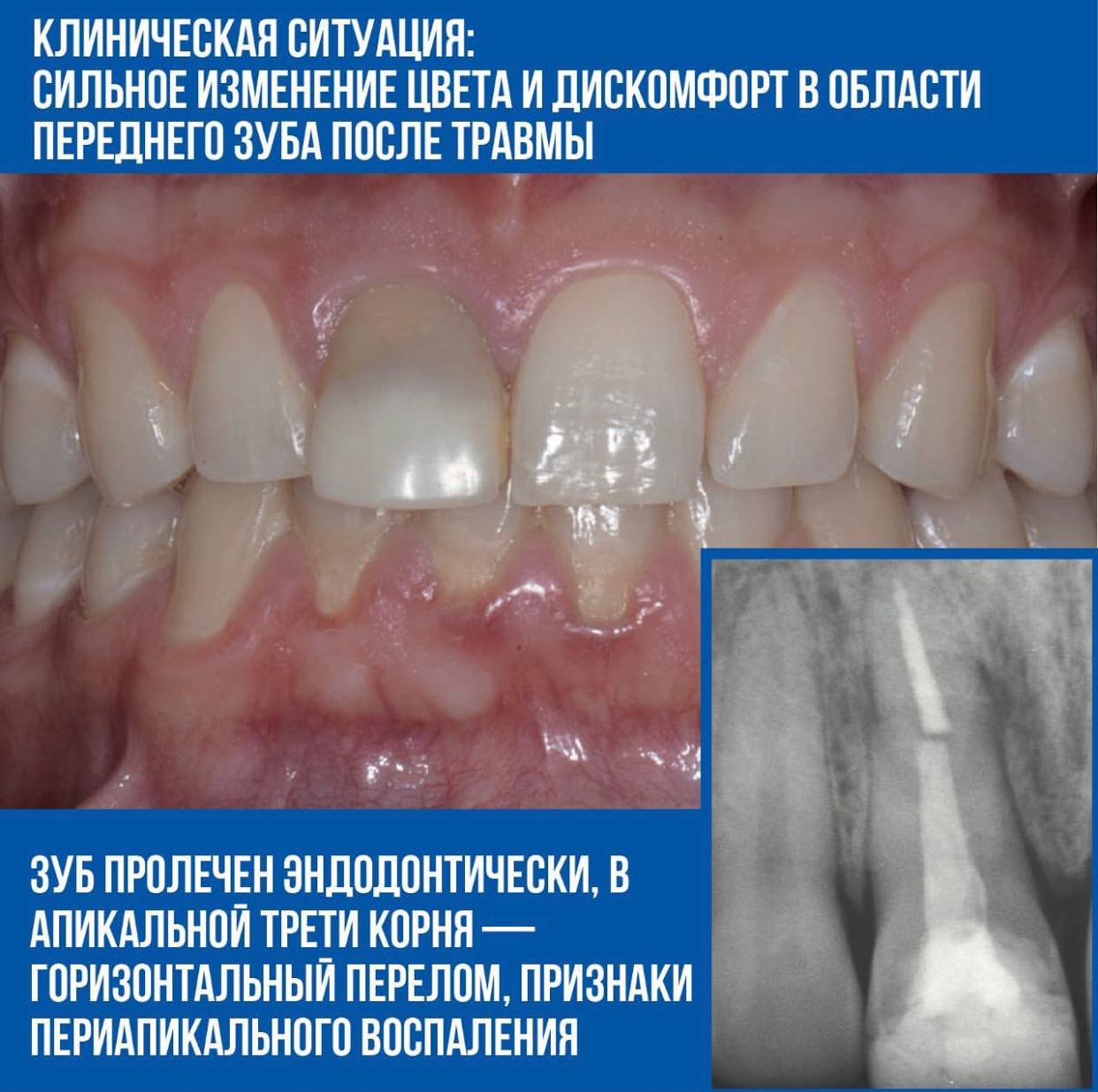 Техника L-shape. Клинический случай Рональда Юнга